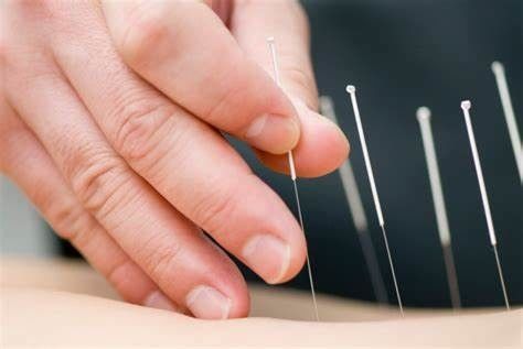 Customizable Stainless Steel Disposable Acupuncture Needles With Guide Tube