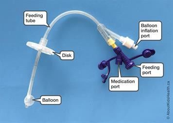 Medical Silicone Gastrostomy Feeding Tube PEG For Percutaneous Endoscopic Gastrostomy Different Sizes