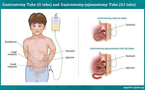 Medical Silicone Gastrostomy Feeding Tube PEG For Percutaneous Endoscopic Gastrostomy Different Sizes