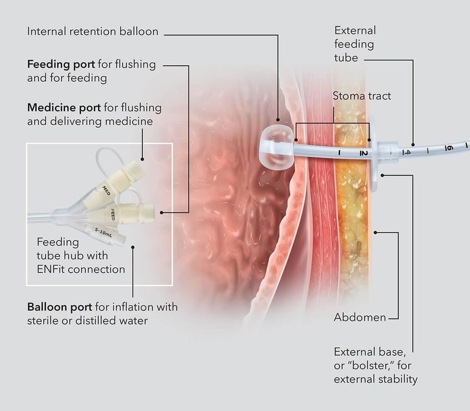 Medical Silicone Gastrostomy Feeding Tube PEG For Percutaneous Endoscopic Gastrostomy Different Sizes