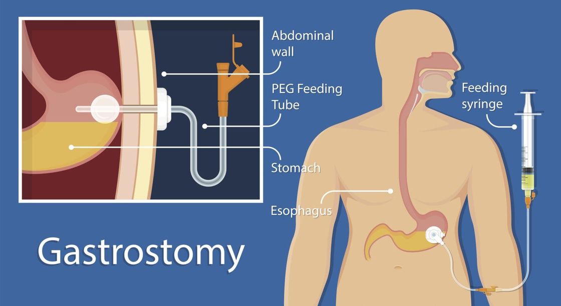 Medical Silicone Gastrostomy Feeding Tube PEG For Percutaneous Endoscopic Gastrostomy Different Sizes